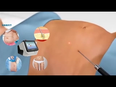 ওজন কমানোর জন্য লেজার লিপো সরঞ্জাম 30W 60W 980nm ডায়োড লিপো লেজার মেশিন